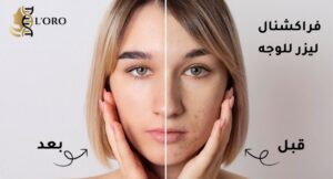 علاج تصبغات الوجه بالليزر