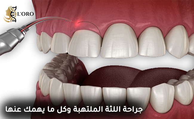 جراحة اللثة الملتهبة