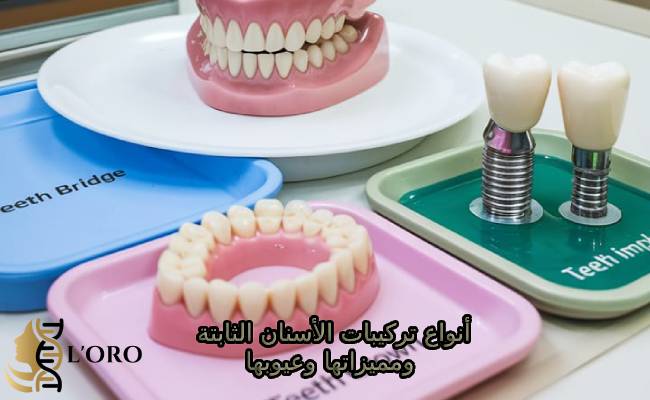 تركيبات الأسنان الثابتة